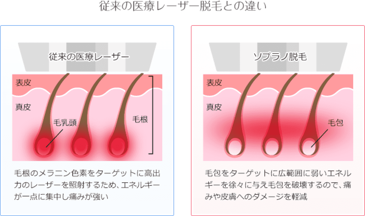 従来の医療レーザー脱毛との違い
